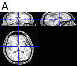 MRIによる3次元画像